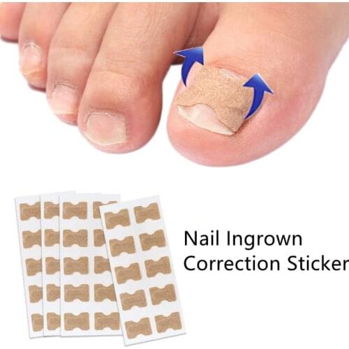 10Pcs Nail Art Ingrown Correction Sticker Foot Care Pedicure Tool Fixer Paronychia Recover Toenail Elastic Patch Corrector