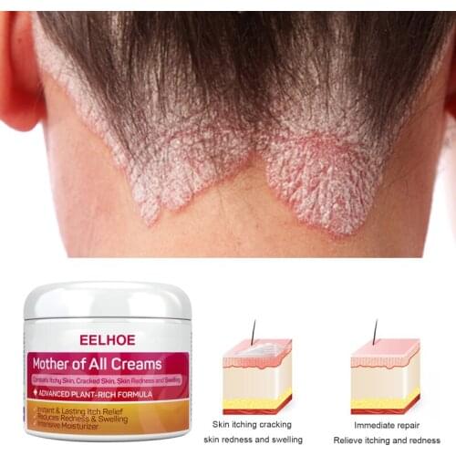 Herbal Antibacterial Cream Skin Psoriasis Cream Dermatitis Eczematoid Eczema Ointment Psoriasis Skin Rash Urticaria Desquamation