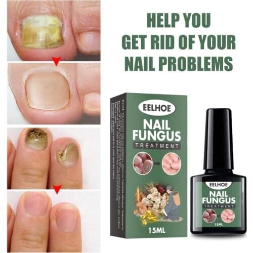 Foot Cute Nail Repair Liquid Hand And Foot Onychomycosis Care Repair Onychomycosis Liquid Antibacterial Thickening Nail Care