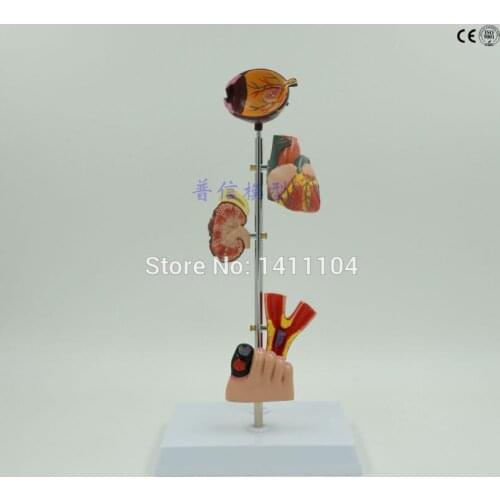 Free shipping&Human organ anatomy, Medical anatomy, diabete pathologic model,thrombus,Fundus artery disease, arterial disease