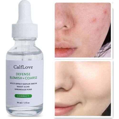 Salicylic Acid Solution Face Serum Acne Treatment Face Essence Shrink Pores Serum Oil Control Close Mouth Smooth Skin Care 30ml