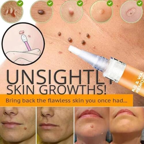 1Pcs 2Pcs Warts Cream Treatment Remover Antibacterial Ointment Skin Tag Remover Herbal Extract Foot Corn For Callus Warts Plaste