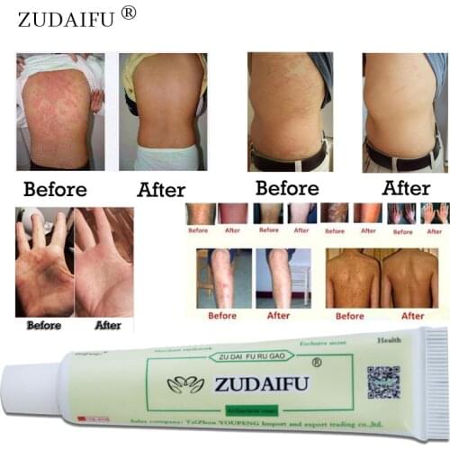 Dropship hot sell ZUDAIFU Body Psoriasis Cream Skin Care Without Retail Box Remove Psoriasis Eczema Give many gift for you