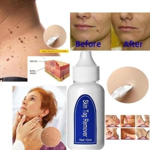 10ml 20ml 30ml Wart Removal Beauty Liquid Genital Wart Treatment Papillomas Removal of Warts Liquid From Skin Tags Removing