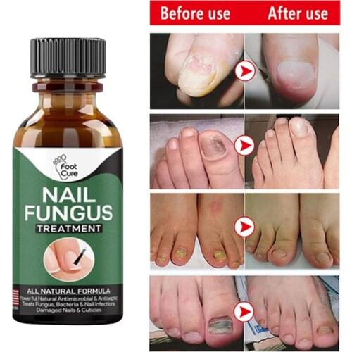 Fast Nail Fungal Treatments Nail Repair Essences Serum Care Treatments Foot Nail Fungus Removal Gel Paronychia Onychomycosis