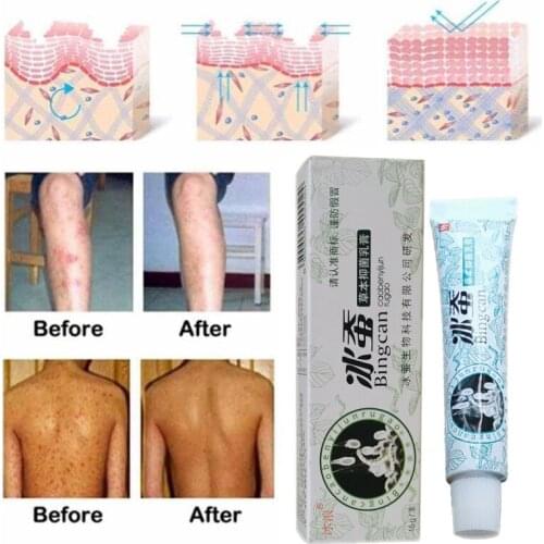 Health psoriasis treatment cream Skin care Dermatitis Eczematoid Eczema Ointment eczema cream psoriasis Itching relief Ointment