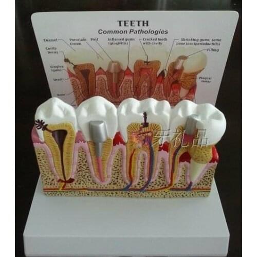 Detachable tooth anatomical model seat Teeth common pathologies Dentistry Dental model