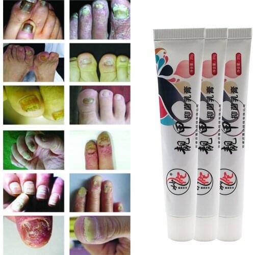 Chinese Medicine Herbs Toe Nail Fungus Treatment Removal Anti Onychomycosis Paronychia Anti Fungal Toe Repair Cream