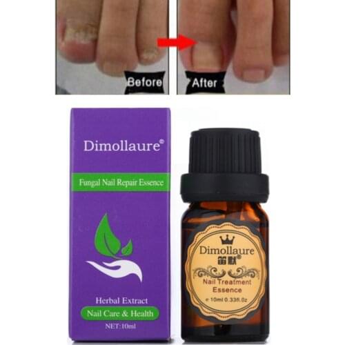 2pcs Dimollaure Herbal Fungal Nail Treatment Essence Hand Foot Toe Nail Fungus Removal Infection Feet Care Nail GelParonychia