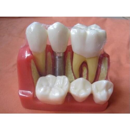 Free shipping Dental teeth model dental planting teeth model decomposition tooth model exploded removable dental teaching model