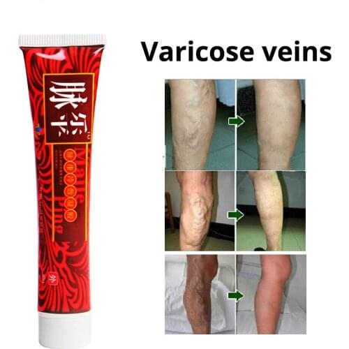 Varicose Veins Treatment Cream Ointment Vasculitis Angiitis Phlebitis Spider Veins Pain Remedy Herbal Body Cream DropShipping