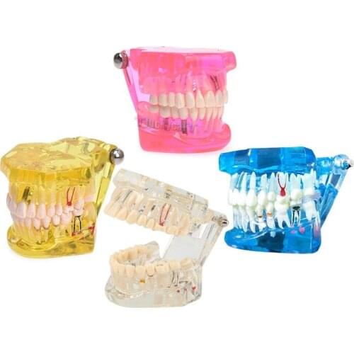 1Pcs Dental Model Teeth Implant Restoration Bridge Teaching Tooth Medical Science Disease Malocclusion Orthodontic Model
