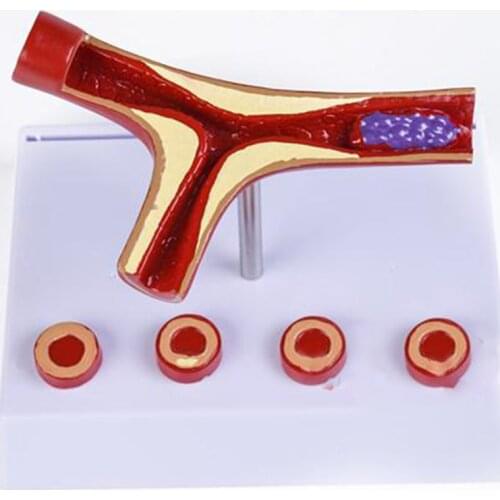 10X Enlarge Human Arterial Coronary Arteriosclerosis Atherosclerosis Coronary Model Cross Section Heart Disease Thrombus Model