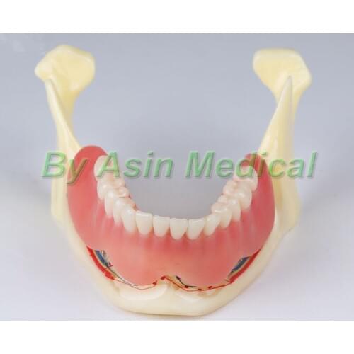 New arrival Resin mandibular denture Coverage model Mandible belt nerve model Display dentures Removable teeth model