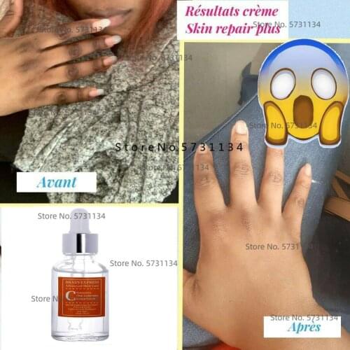 Corrective skin-lightening cream for hyperpigmentation for hands, feet
