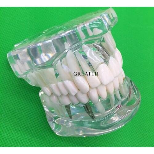 Teeth Model Dental Implant Disease Teeth Model With Restoration Bridge Tooth Dentist For teaching