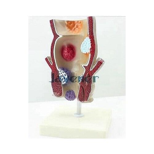 Magnify Human Anatomical Anorectal Anatomy Medical Pathology Model