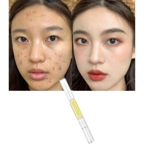 Whitening Freckle Vitamin K Cream Liquid Remove Melasma Acne Spot Pigment Melanin Dark Spots Moisturizing Skin Care Pen