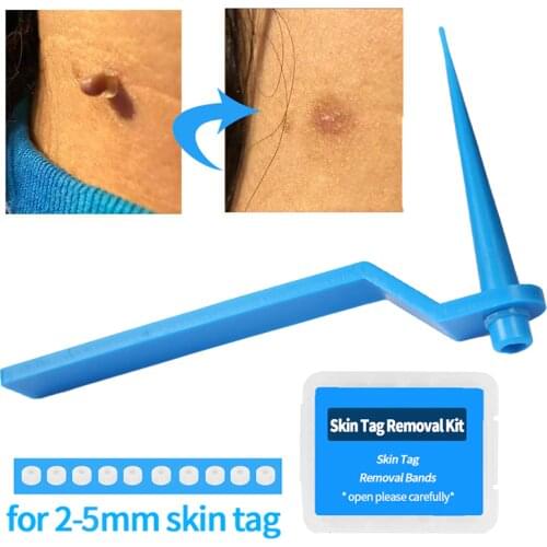 Micro Band Non Toxic Face Care Mole Wart Tool For Small To Medium Blue Skin Tag Removal Kit With Cleansing Swabs Home Use Adult