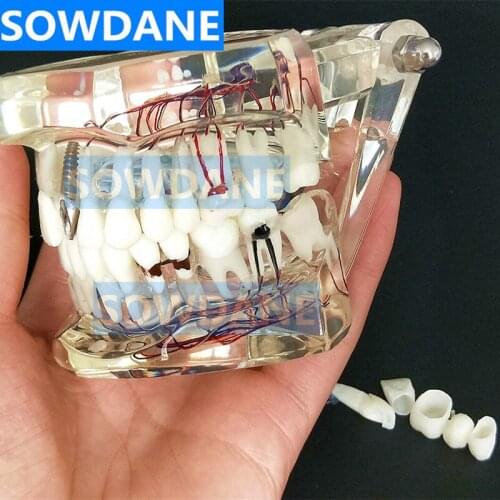 Dental Implant Disease Teeth Model With Restoration Bridge Tooth Dentist For Medical Science Dental Removable Model with Nerve