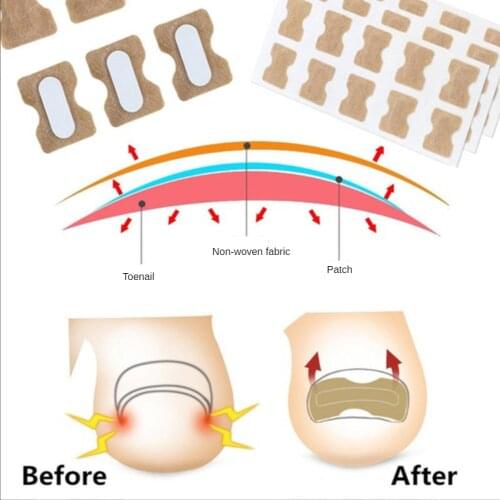 Ingrown Toenail Corrector Sticker Paronychia Treatment Fixer Recover Corrector Pedicure Foot Toe Nail Care Tool Glue Free Normal
