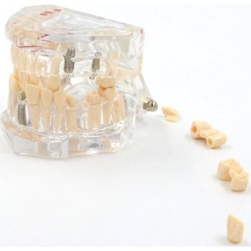 Supply dental model transparent pathological repair human dental model