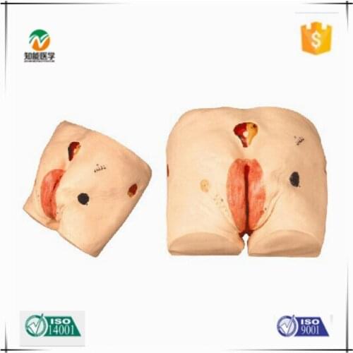Chinon Senior Decubitus Pressure Ulcers Bedsore Nursing Model Medicine Student Medical Science Teaching Sources Supply BIX-H10