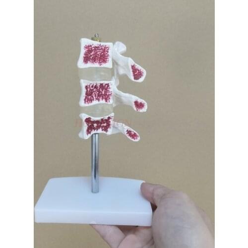 Osteoporosis model spine and cervical spine model osteoporosis joint model bone model