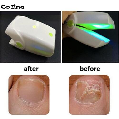 Laser therapy device for nail laser toe nail fungus treatment device finger nails health care Onychomycosis Laser CE