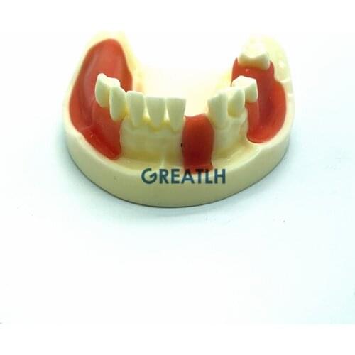 Dental Lower Jaw model Implant Practice model Typodont Teeth Model with Gingiva