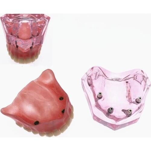 Dental Overdenture Superior with 4 Implants Demo Model Dental Teaching Study Demonstrate Model #6001 01