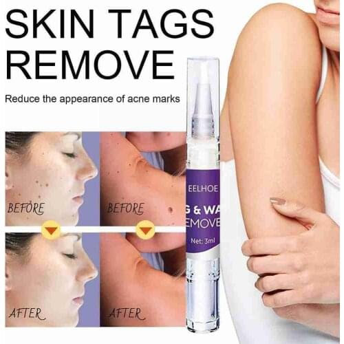 Warts Warts Flat Warts Skin Repair No Trace Beauty Removal Skin Papilloma Of Dropshipping Mole Liquid Pen Treatment Warts M0J8