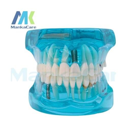 Manka Care - Restoration with Implant Oral Model Teeth Tooth Model