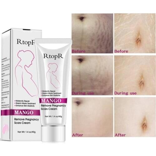 Mango Remove Pregnancy Acne Scar Stretch Mark Cream Treatment Maternal Anti-Aging Repair Anti-Wrinkle Firming Body Cream TSLM1