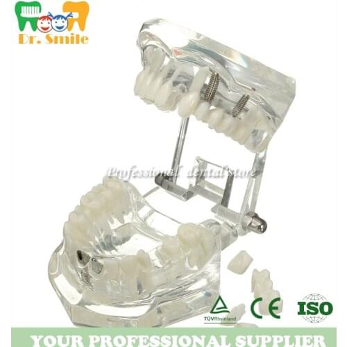 Removable Dental Implant Disease Teaching Teeth Model & Restoration Bridge Tooth