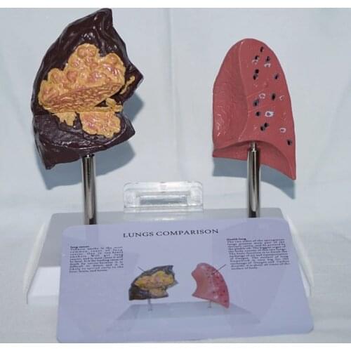 Smoking Lung and Normal Lung Comparison Organ Model-pathological Lung Anatomy Model- for Study Teaching Medical Model