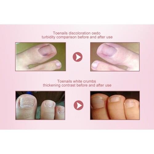 Herbal Fungal Nail Treatment Essential Oil Toenail Care Nail Gel Effective