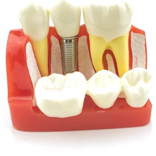 Teeth Model Dental Teach Analysis Crown Bridge Removable Model Oral Education Equipment #2017