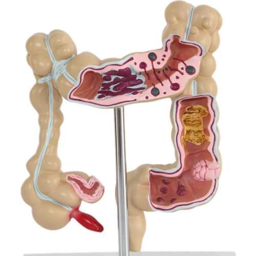 Colorectal lesion model human colon snake large intestine pathological diseases model medical organizer anatomy
