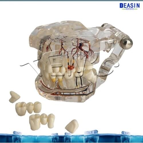 NEW dental standard implant model with nerve for student learning