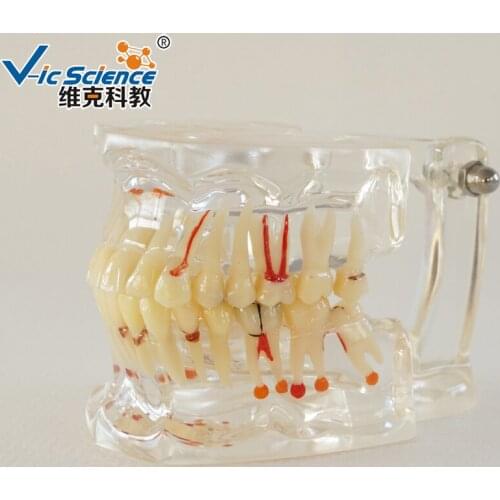 Dental Model Full Mouth Teeth Pathology Model With Half Implant