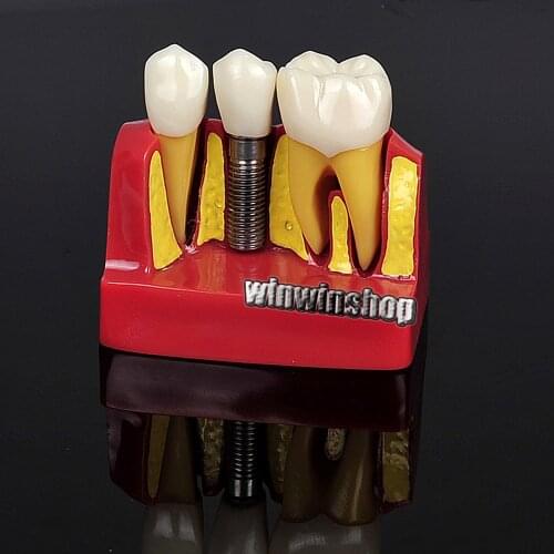 Dental Implant Analysis Crown Bridge Demonstration Dental Teeth Model 2017