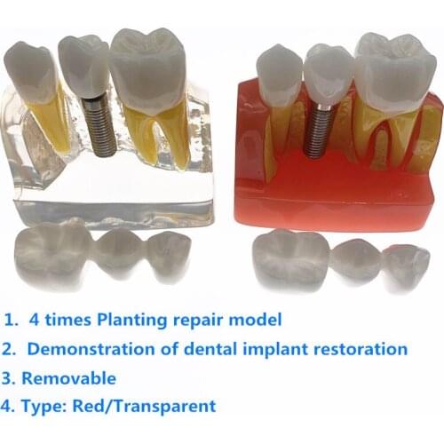 4 times planting Teeth model Analysis Crown Bridge Removable Model Dental Demonstration Teeth Model