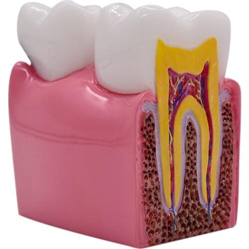 1pc 6 Times Dental Caries Comparsion Models Tooth Decay Model For Dental Study Teaching Dental Anatomy Education Teeth Model