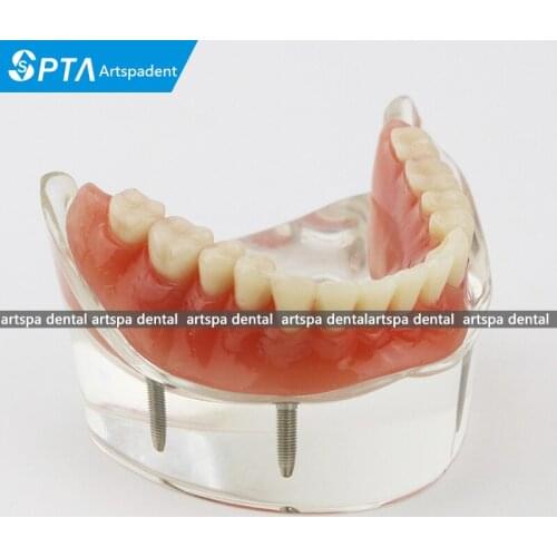 Dental Teeth Study Model Overdenture Inferior 4 Implant Demo Model