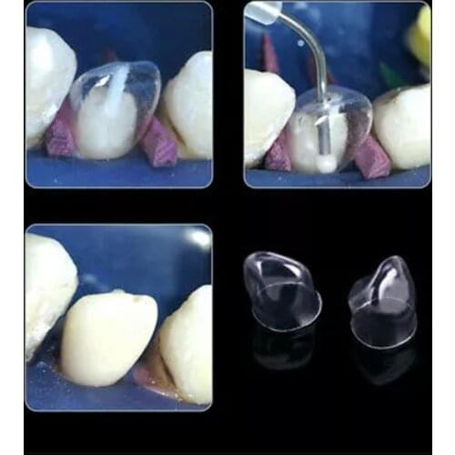 64 Pcs/Pack 1.910/1.912 Dental Transparent Crown Anterior /Posterior/Deciduous Matrices Matrix for Adult TOR BM