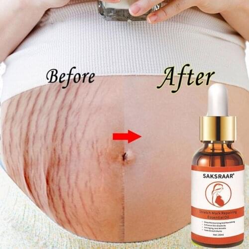 Free Shipping Stretch Marks Remover Essential Oil Eliminate Pregnancy Scars Maternity Repair Anti Winkle Skin Firming Treatment