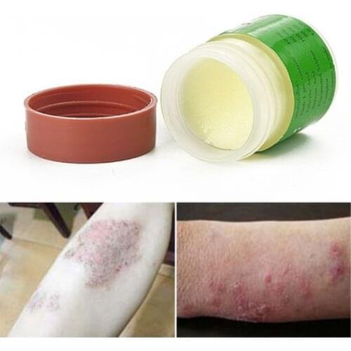 1Pcs 100% Original Powerful Cure Psoriasis Ointment From Vietnam Native Medicine Ingredient Security Eczema Itching Dermatitis