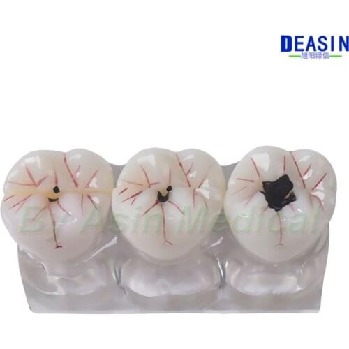 Dental model four times caries evolution caries model tooth demonstration doctor-patient communication caries development proces