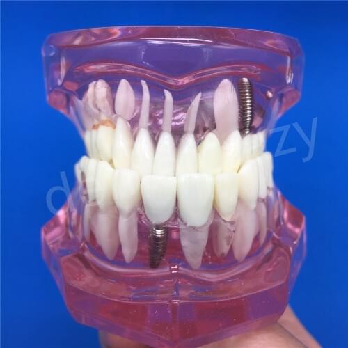 Dental Implant Disease Teeth Model With Restoration Bridge Tooth Dentist